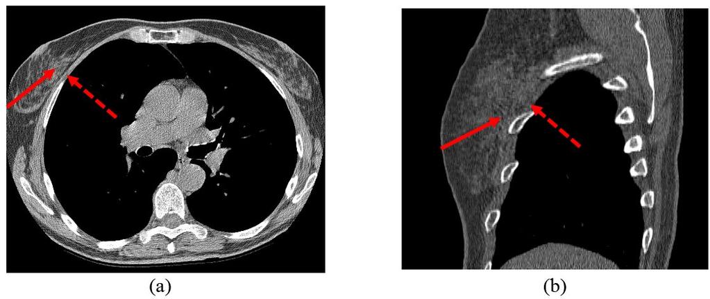 CT (a) axial slice and sagittal slice. Solid arrows mark glandular tissues in the breast and dashed arrows mark the muscles in the pectoral regions.