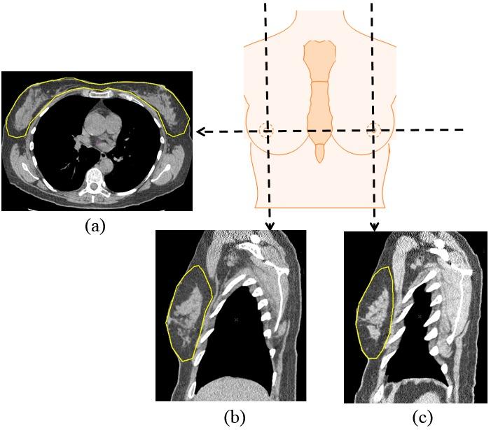 (c) Figure 9. Example of ground truth (indicated by yellow contours) annotated by a radiologist on (a) one axial slice and (b, c) two sagittal slices for one CT scan. 4.