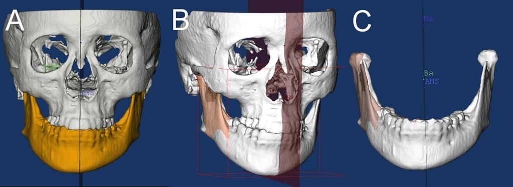 Figure 9. Three-dimensional image mirroring on the midsagittal plane: Mirroring can be a valuable technique in the treatment of asymmetries. As shown below the mandible (A) has been colored yellow.
