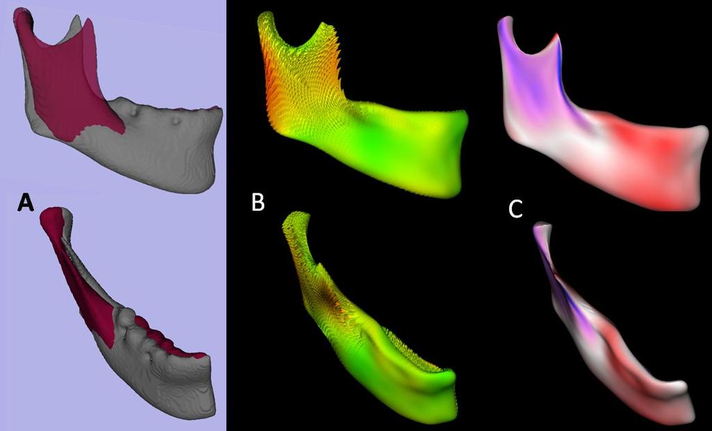 Figure 13. Quantification of mandibular asymmetry for a patient using Shape Correspondence.