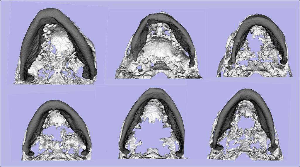 Figure 14. Examples of yaw in mandibular asymmetry. Inferior view of mandibular models for 6 patients.