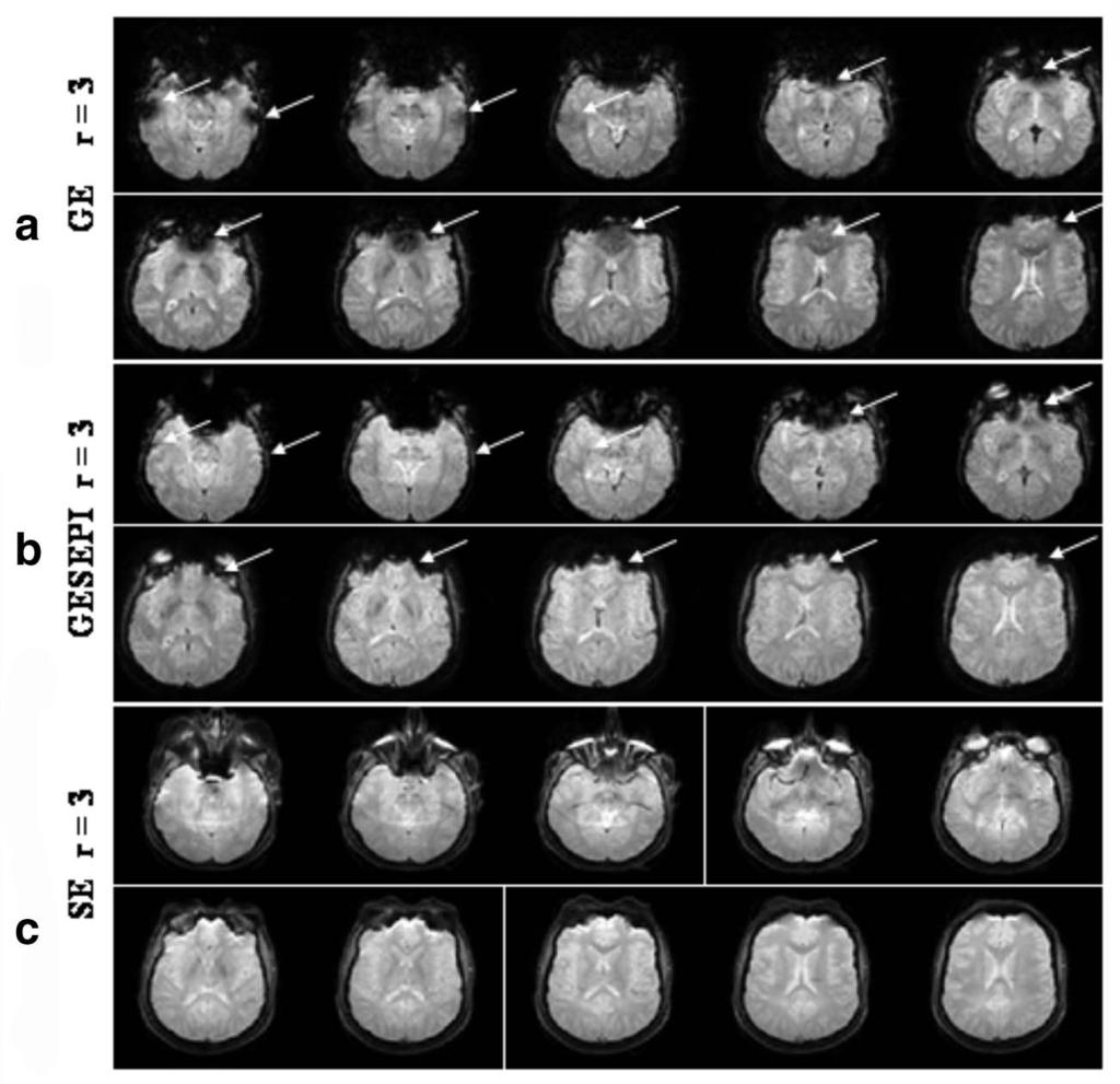 Figure 16. The EPI images were acquired from the same human brain volume with SENSE (r = 3) using the GE (a), GESEPI (b), and SE (c) methods.