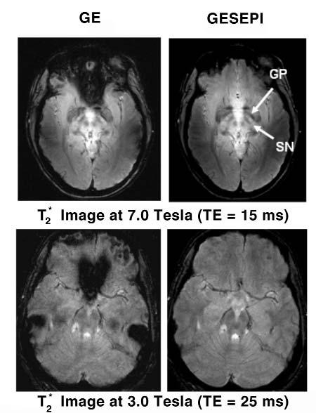 Figure 9. GESEPI effectively removed signal-loss artifacts in heavily T 2 *-weighted images at 3.0 and 7.0 Tesla. All the images have the same slice thickness 5 mm.