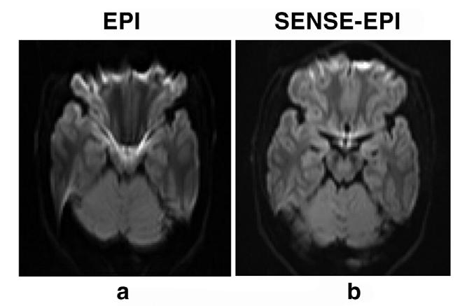 Figure 15. Spin-echo EPI images acquired without (a) and with SENSE with a reduction factor r = 3 (b) from an inferior brain slice.