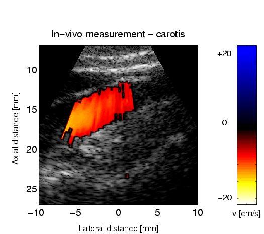 In-vivo SA Flow Image Parabolic Profiles from Flow Rig Parabolic velocity profile