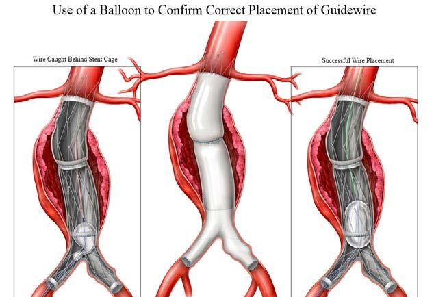Content Figure 5: Use of a Balloon to Confirm Correct Placement of Guidewire *Note: Figure 5 corresponds to Figure 18 of the IFU WARNING: Balloon inflation and advancement should be performed slowly
