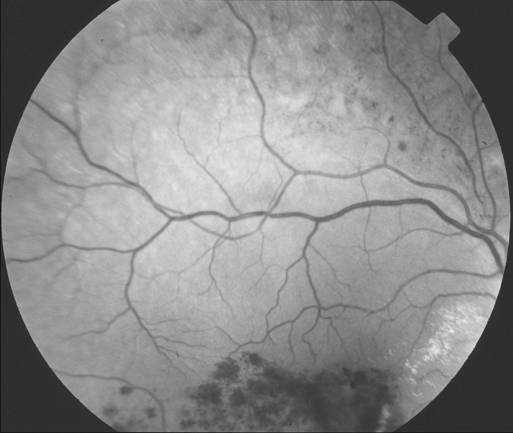 2 RPI-CS-TR 03-1 Fig. 1. Retinal images taken 3.5 years apart of a patient having a branch vein occlusion.