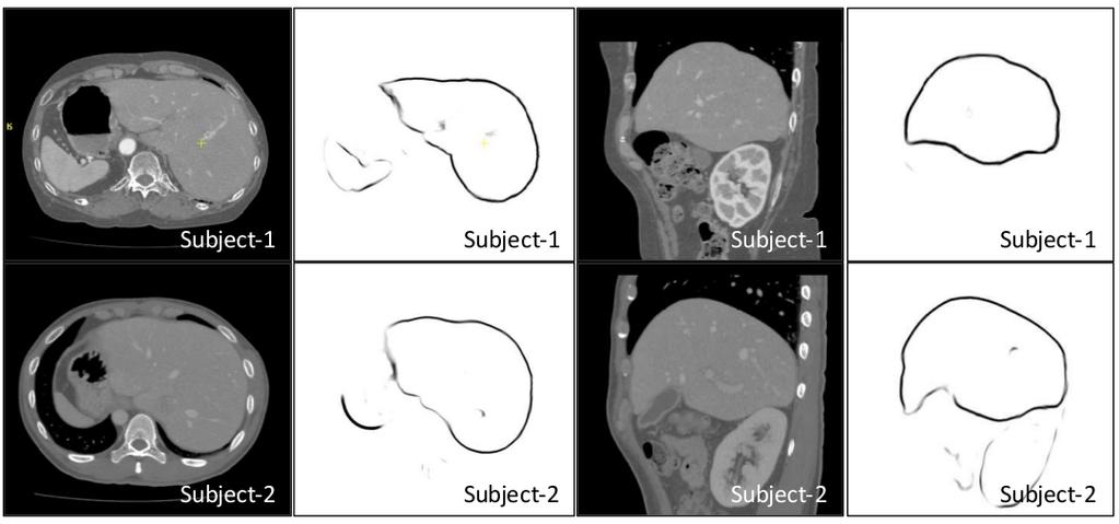 80 Chapter 3. Multi-Modal Cardiac Image Analysis through Probabilistic Edge Maps atlas, shown in (b-d), is represented with the AHA-17 segment model [41]. As can be seen in Figure 3.
