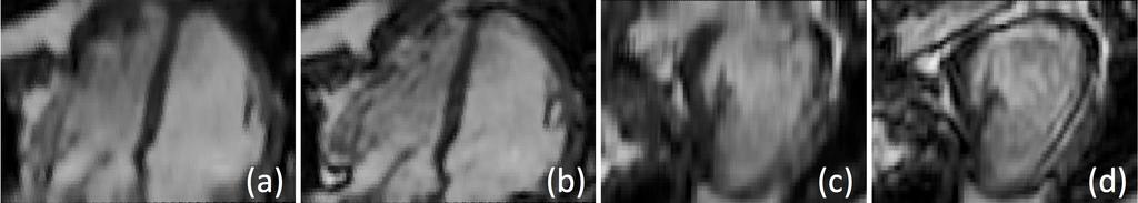 5.4. Discussion and Conclusion 117 Figure 5.5: The LV is better visualized by using multi-input images (b,d) compared to single image SR (a,c).
