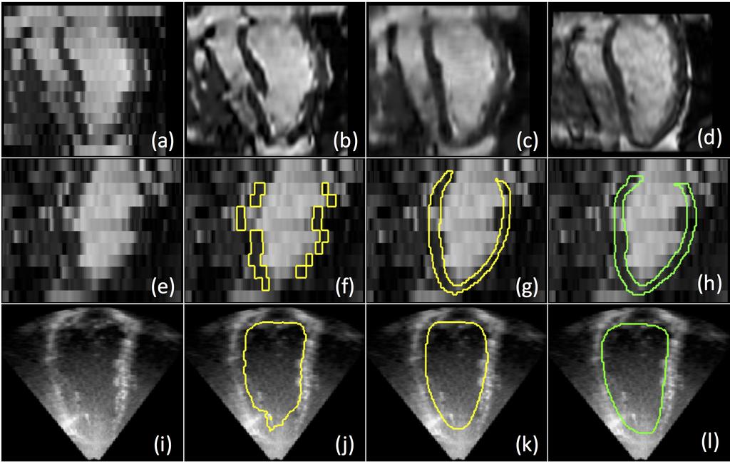 6.1. Introduction 123 Figure 6.1: Results for cardiac MR super-resolution (SR) (top), MR segmentation (middle), and ultrasound (US) segmentation (bottom).