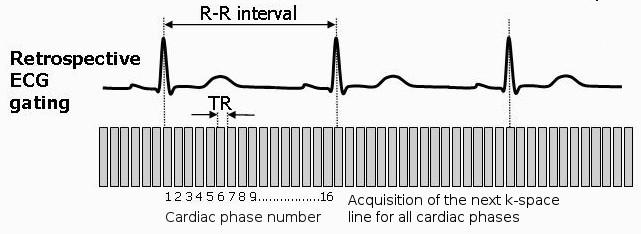 6 Chapter 1. Introduction Figure 1.5: Cine MR images for all cardiac phases (N = 16) are acquired over multiple cardiac cycles in segments of k-space data during breath-hold.