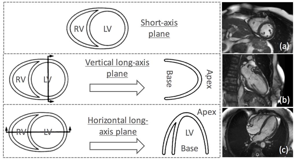 8 Chapter 1. Introduction Figure 1.6: The standard cardiac cine imaging planes [93]: short-axis mid-ventricle plane (a), vertical long-axis plane (b), and horizontal long-axis plane (c).