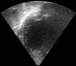 (III-IV) 3D-US and MR scans acquired from the same subject. Some of the structures are difficult to identify and locate in the apical ultrasound view such as the apex and right ventricle.