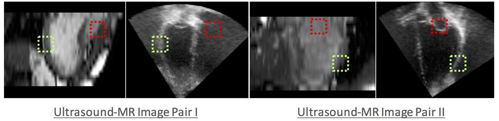 2.3. Multi-Modal Cardiac Image Registration 31 Figure 2.7: Two pairs of cardiac 3D-US and MR images, acquired from same subject, are shown.