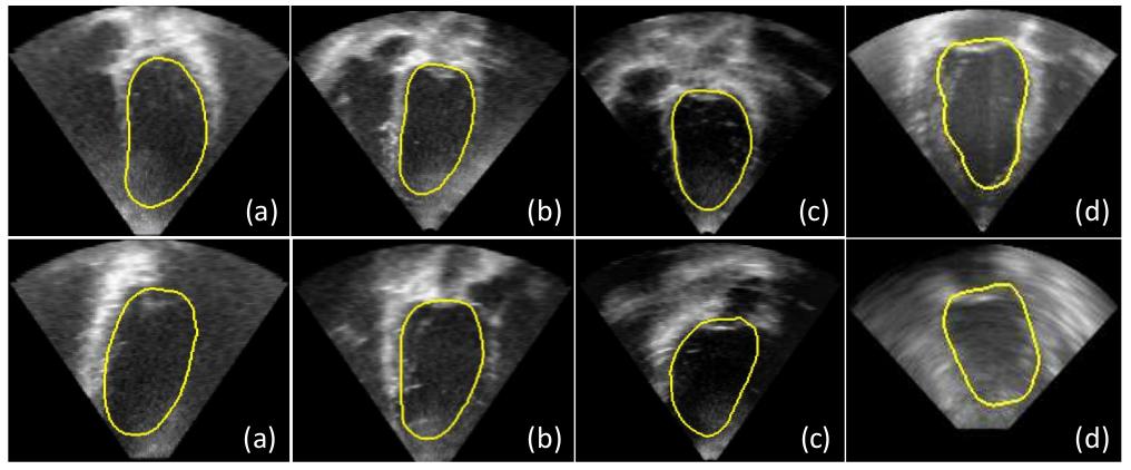 3.4. Multi-Atlas Segmentation of Cardiac Ultrasound Images with PEMs 69 Figure 3.9: 3D-US cardiac image segmentation results obtained using multi-atlas fusion and PEM representation techniques.