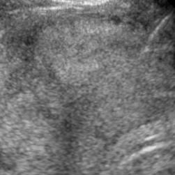 One of the most important problems in image guided interventions for ultrasound images is the precise tracking and control of biopsy needles.
