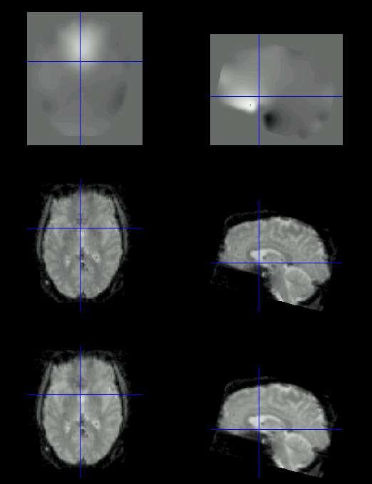 Moveent by Distortion Interaction of fmri *Subject