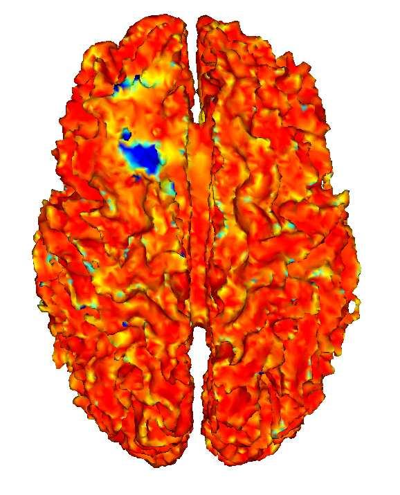 Deformable registration of tumor-occluded brain images Original sequence: 5 scans, total