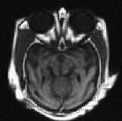 Figure 12. Fused image In medical, CT and MRI image both are tomographic scanning images. Both images have different features. Fig.10.