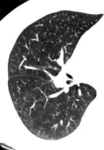 CAD marks subtle lesions Marking subtle lung nodules may improve physician performance Physician must be able to identify CAD