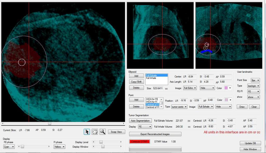 104 4.3.3 Clinical software for strain gauge calibration Figure 4-16: The user interactive interface to quantify DTMR after reconstruction of both full exhale and full inhale phase of MVCBCT.
