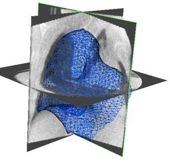 Using our in-house software platform, the MVCBCT image without MC is rigidly aligned to the coordinates of the 4DCT using bony anatomic structures (see Figure 5-3a, b).