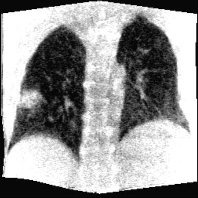 122 (d) (e) Figure 5-8 continued Figure 5-9 shows a single profile aligned in a superior-inferior direction passing through the tumor.