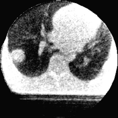 the two small peaks located between the tumor and the lung wall are particularly noteworthy.
