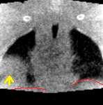 (a) A coronal slice of 3D volume and (b) one projection image of one patient whose diaphragm is not visible in the projection image (indicated by the red ellipse).