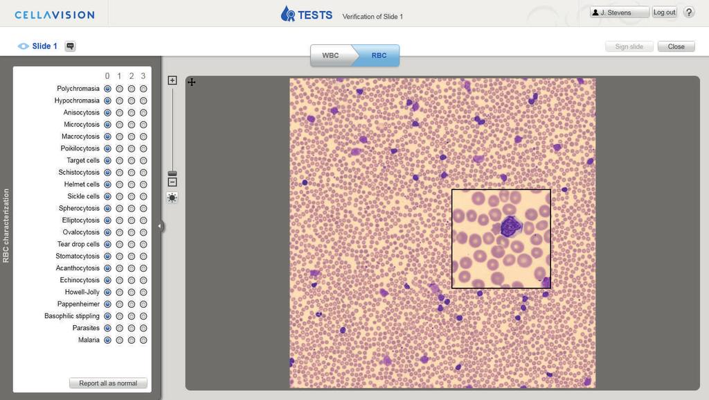 PARTICIPANT CellaVision Proficiency 3.2.3.5 Red Blood Cell Characterization 1. RBC tab 2. Zoom slider 3. Magnified area 4. Report all as normal General Workflow 1. Click on the RBC (1) tab. 2. Zoom in to the RBC image using either the mouse wheel or the zoom slider (2).