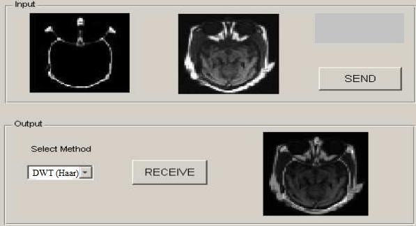 CONCLUSION The fusion of CT and MRI of two modality images improves the view of the images and adds