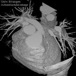 Early Cardiac Spiral CT Single Slice CT (RSNA 1997) Standard