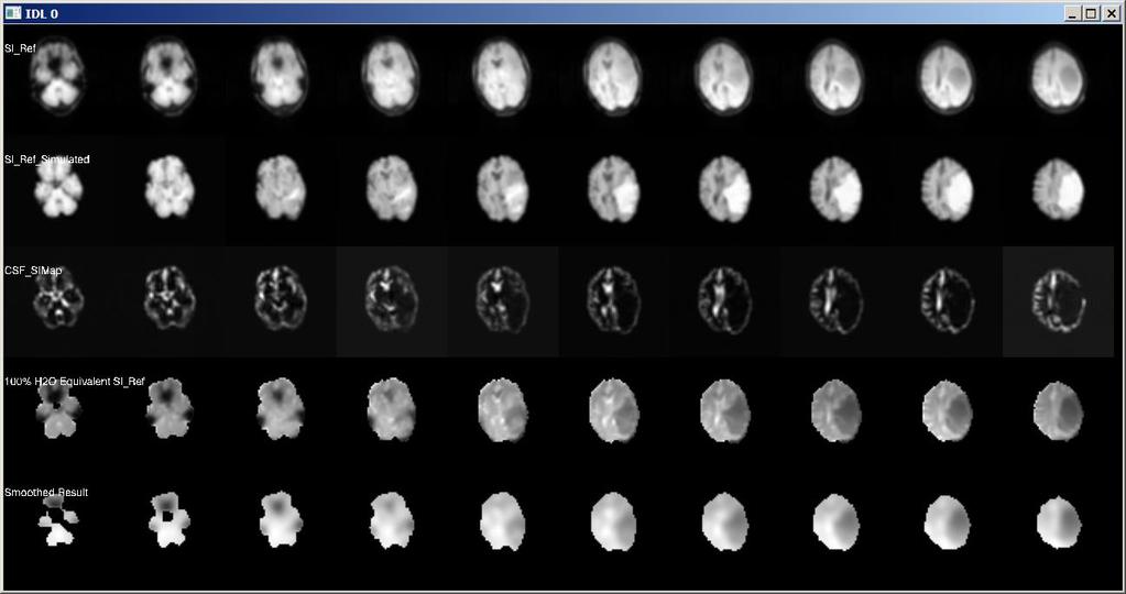 This display shows several slices of the water reference SI through the center of the head. In this example a lesion can be seen on the SI_Ref image shown on the top row.