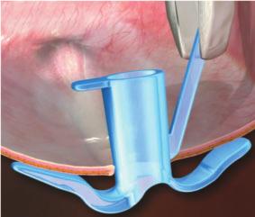 he unique collapse mechanism enables easy, painless extraction and the translucent light blue color allows for clog identification from the outside.