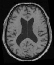 Results: Ischemia T1 MRI T2 MRI PD MRI raw (not pruned): pruned: COCOSCO, ZIJDENBOS,