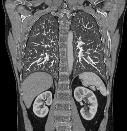 (c): The context-sensitive image is shown in a organ-adapted gray level window (lung in lung window, soft tissue in body window, bone in bone window, etc.