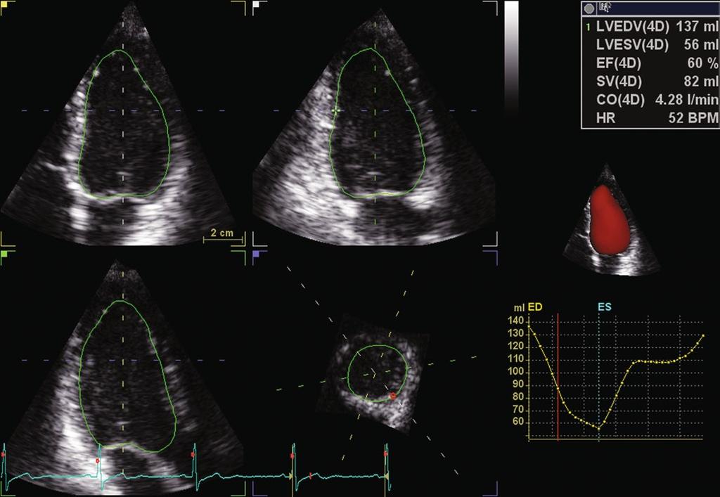 2 Technical Principles of Transthoracic Three-Dimensional Echocardiography 19 noise, such as multiple reflections, clutter noise, drop-outs and shadows, that may confuse the algorithm.