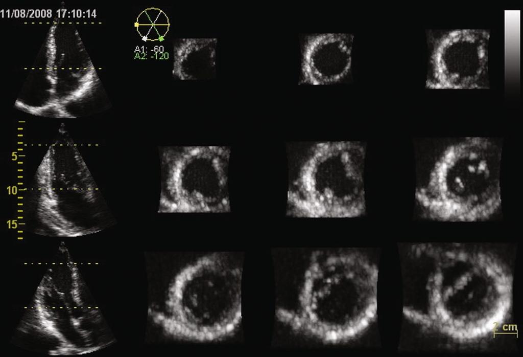2 Technical Principles of Transthoracic Three-Dimensional Echocardiography 15 Fig. 2.