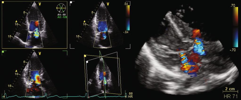16 S.I. Rabben 2.5.3 Surface Rendering An alternative way of displaying cardiac structures and still keep the depth perception is to generate surface rendered models in a 3D scene (Fig. 2.5c).