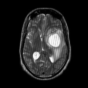 All MR brain images are taken with different views but with same resolution. The sample MR brain images with artifact taken in different view for testing are shown in figure 2. Fig 2.