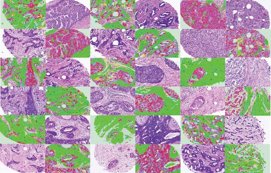 Diagnosing breast cancer with the knn algorithm Dataset: Breast Cancer Wisconsin Diagnostic" from UCI Machine Learning Repository (http://archive.ics.uci.