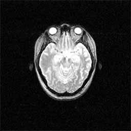 Failed examples of multimodal registration results: (a) reference CT image and  Checkerboard