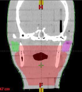 R Parotid L Parotid PTV Figure 18. Coronal view of head and neck treatment plan structures.