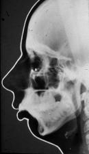 cranio-maxillofacial