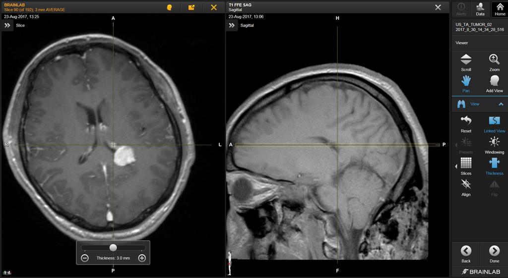 SOFTWARE OVERVIEW You can choose preset windowing settings for CT image sets which are optimized by Brainlab to display particular structures such as bone, lung or soft tissue.