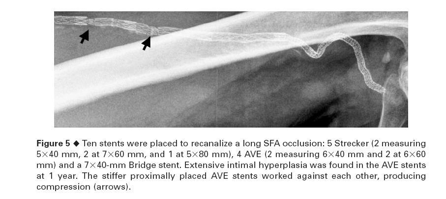 In vivo peripheral stent deformation with leg