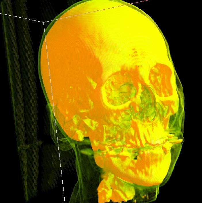 Density field in CT scan: Scalar