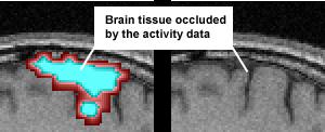 endeing wee developed and we will explain the implementation of these in the following sections. Figue 1: An example of the poblem of occlusion of fmri data ovelaid on an MRI scan. 2.