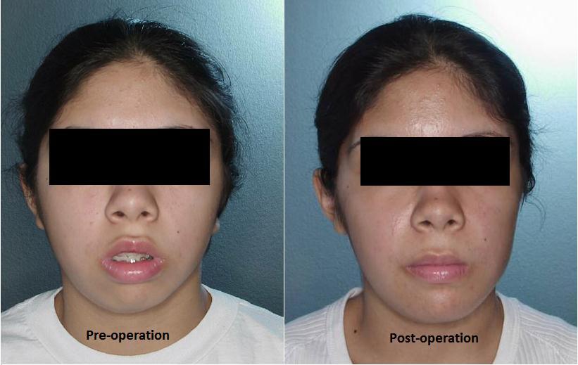 Figure 1. Pre- and post-operative comparison of a successful orthognathic surgery (Diagnosis: relative symmetrical dentofacial deformity).