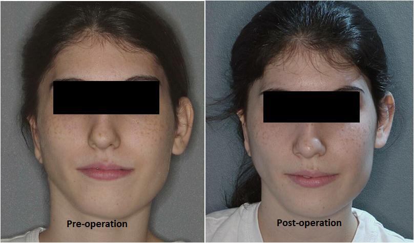 Pre- and Post-operative comparison of orthognathic surgery with insignificant outcome (Diagnosis: hemifacial microsomia - asymmetrical dentofacial deformity).